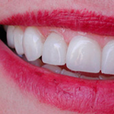Protesis fija diente natural